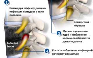 От какой инфекции может болеть спина