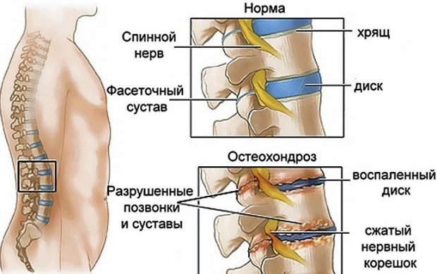 Болит спина отек правой ноги