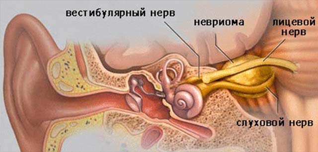 Невринома слухового нерва