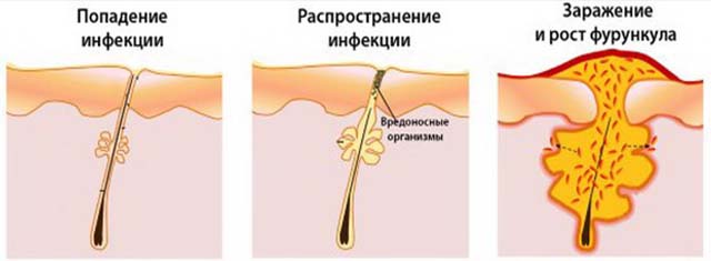 Развитие фурункула