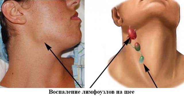 Лимфаденит