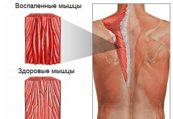 Болит спина шея и ключицы