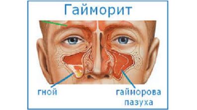 Сильно болит спина и температура 37