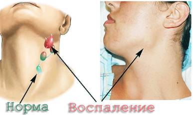 Сильно болит спина и температура 37