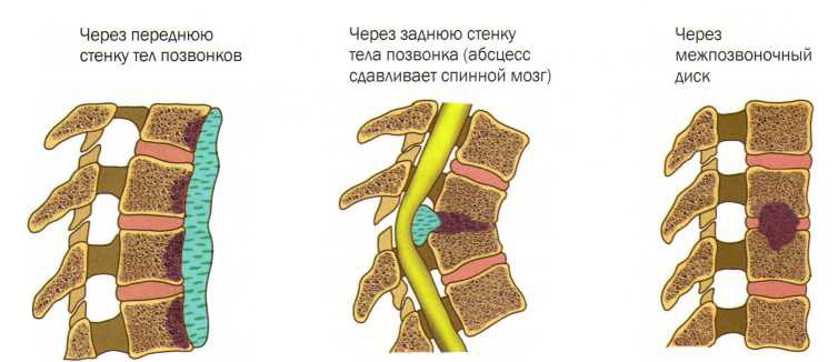 Болит спина отек правой ноги