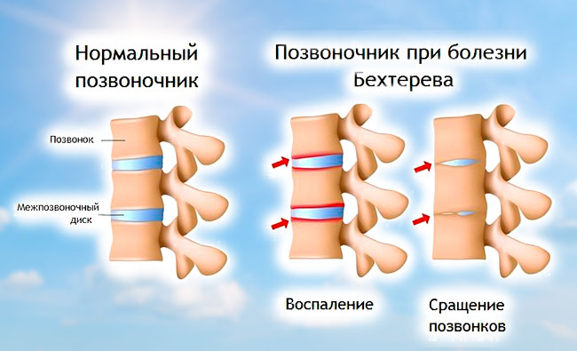 Болит спина отек правой ноги