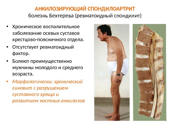 Спина болит когда утром встаю