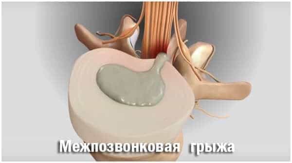 Межпозвоночная грыжа диска
