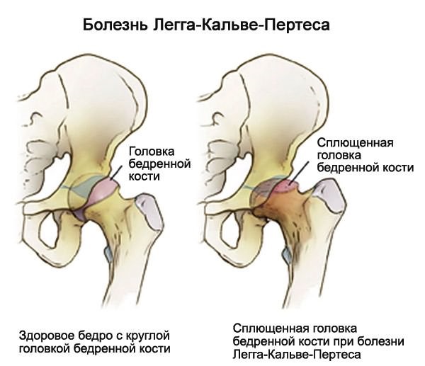 Если ноют колени и болит спина сразу убирайте из рациона