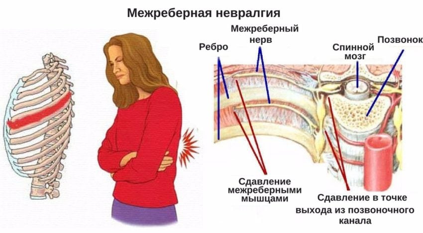 От чего болит в левом подреберье и отдает в спину