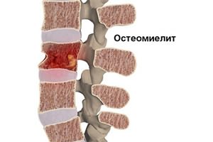 Сильно болит спина и температура 37