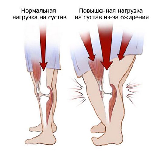 Если ноют колени и болит спина сразу убирайте из рациона