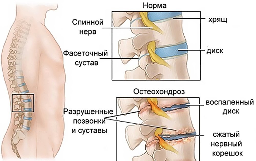Болит в левом боку внизу спины у мужчин