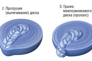 от прыжком болит спина